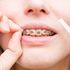 Cera para brackets: Tu mejor aliada para aliviar las molestias de la ortodoncia