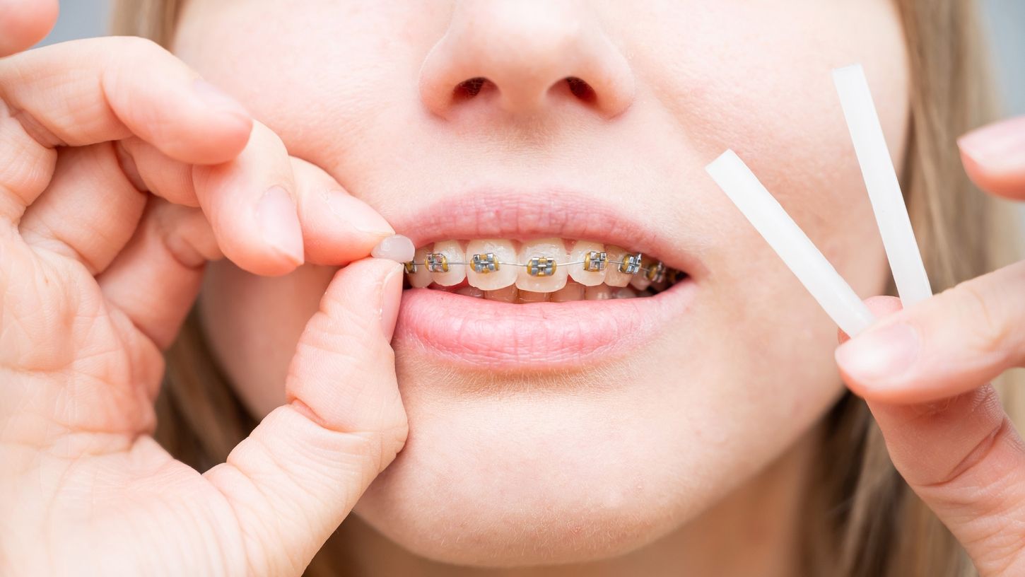 Cera para brackets: Tu mejor aliada para aliviar las molestias de la ortodoncia