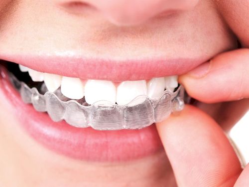 Conoces las fases del tratamiento con ortodoncia Invisalign®