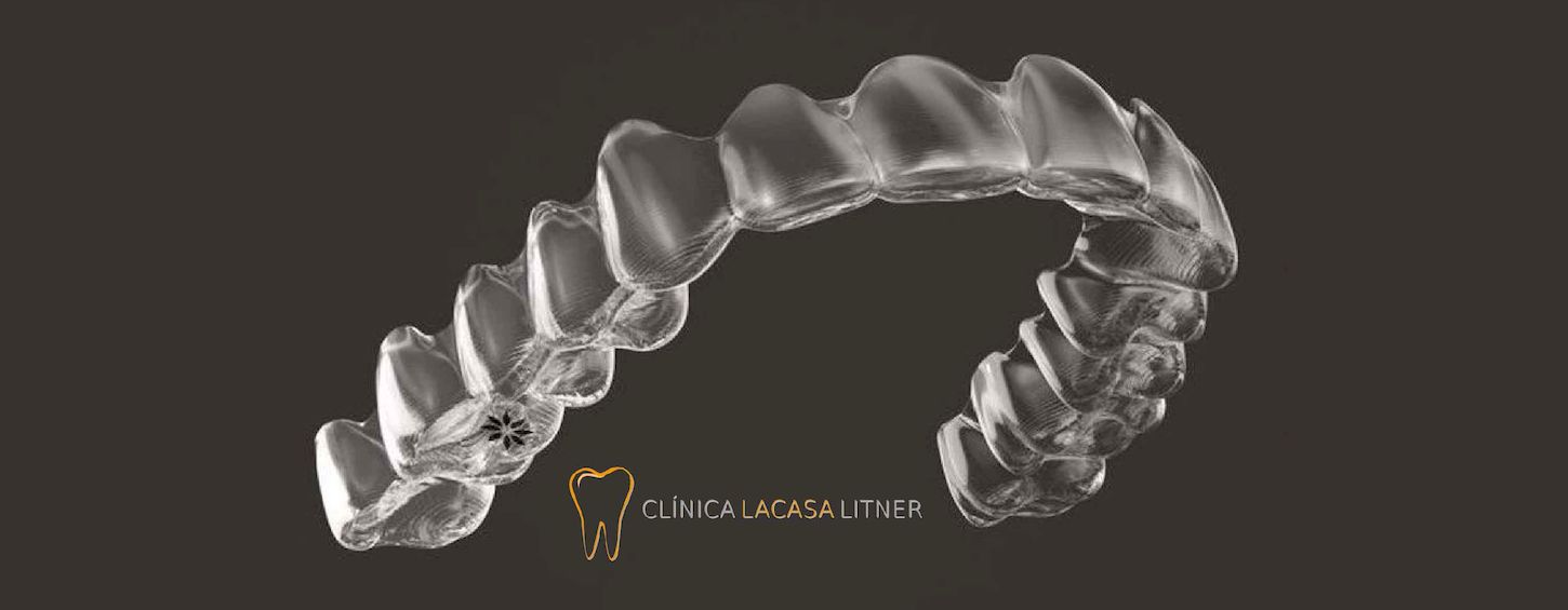 Las 5 fases del tratamiento con ortodoncia Invisalign®