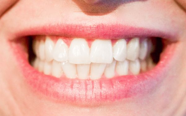 Las 9 ventajas de ponerse implantes dentales clinica dental lacasa litner valdemoro
