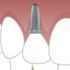 Las 9 ventajas de ponerse implantes dentales