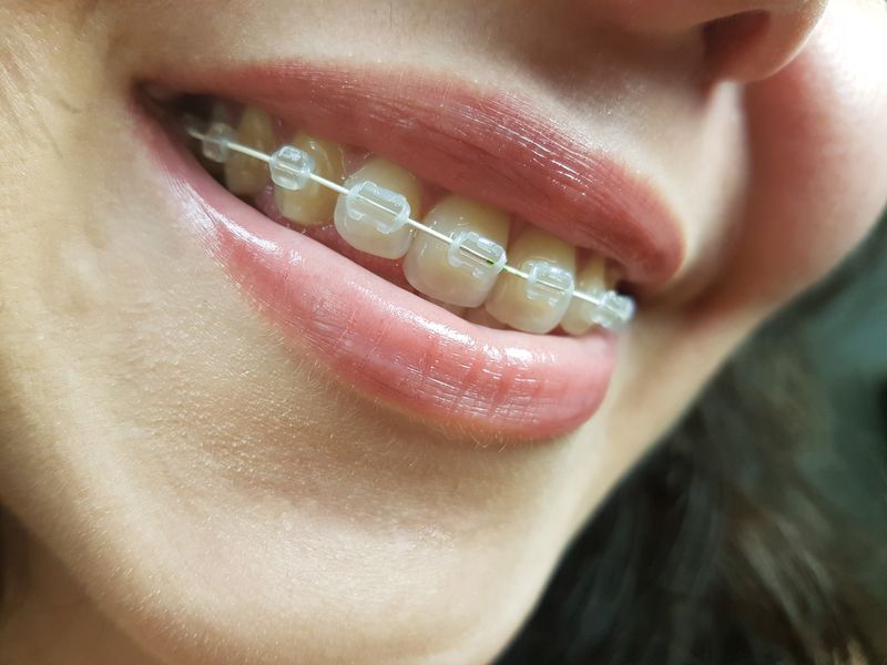 Qué opción elegir: Brackets o alineadores transparentes