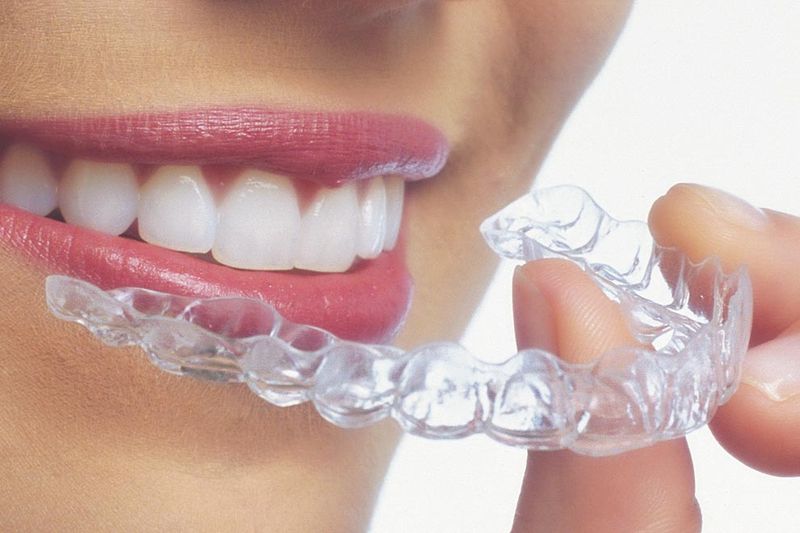 Qué opción elegir: Brackets o alineadores transparentes