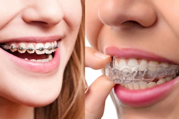 ¿Qué opción elegir: Brackets o alineadores transparentes?