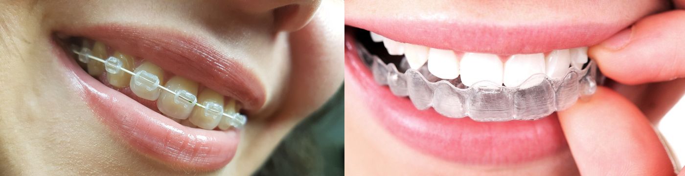 ¿Qué opción elegir: Brackets o alineadores transparentes?