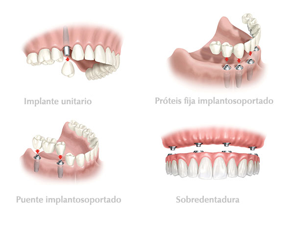 Implantes