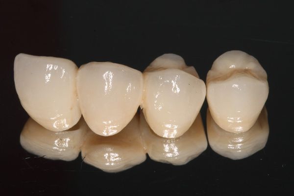 CORONAS SOBRE DIENTE NATURAL Prótesis dental