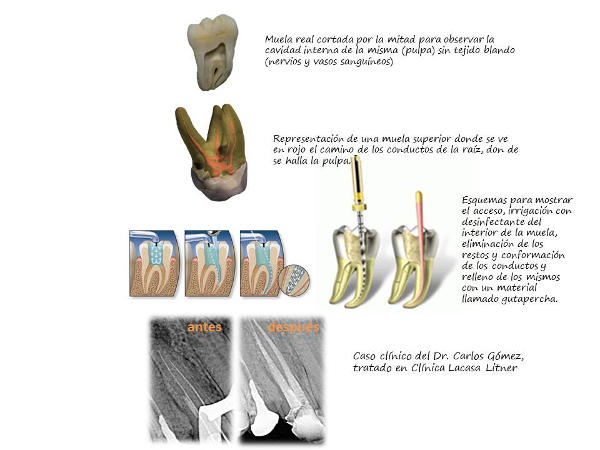 Endodoncia