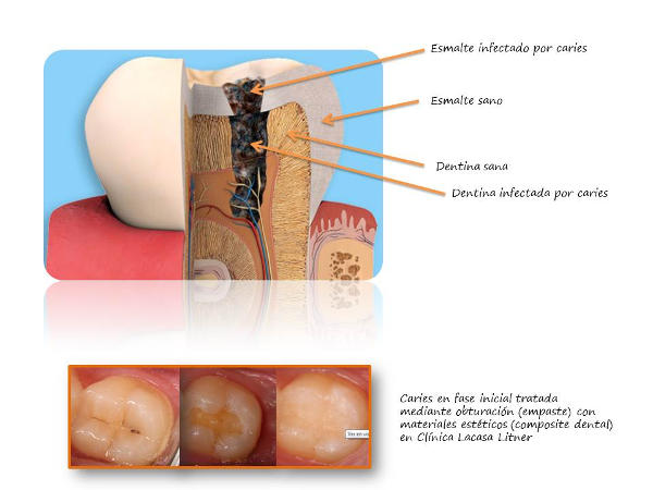 Opturación dental