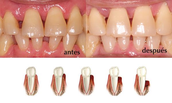 Periodoncia valdemoro tratamiento periodontitis